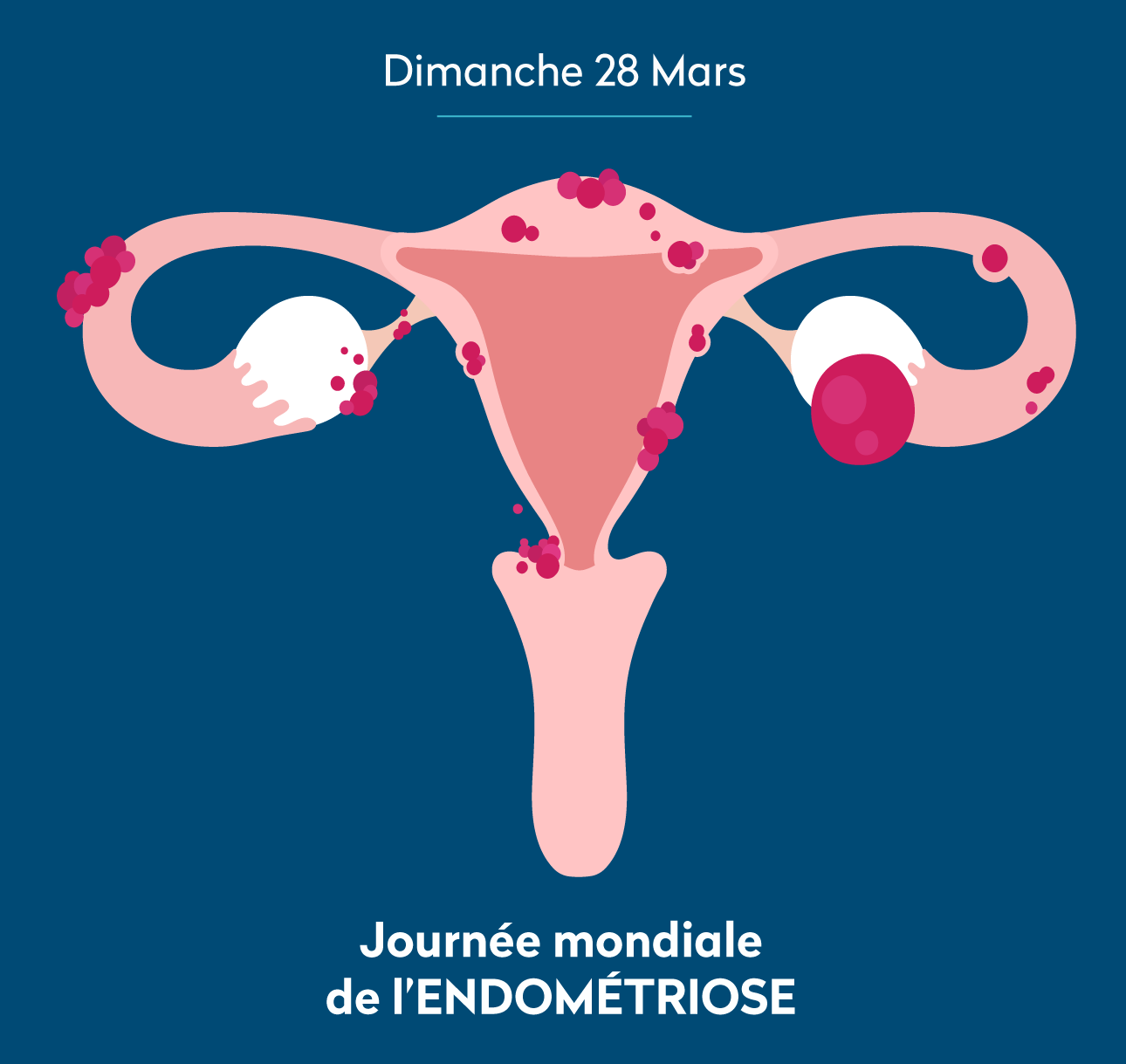 Journée mondiale de l'Endométriose - Medicina Santé